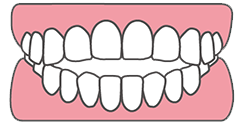 開咬（前歯で物が噛めない）