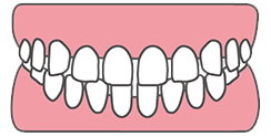 咬み合わせが深い（過蓋咬合）