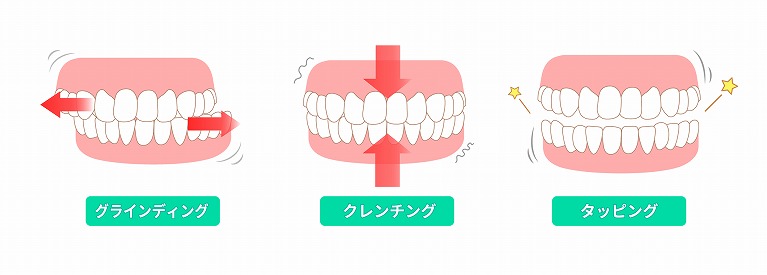 歯ぎしりの種類