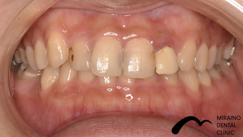 歯の破折予防：MTMの症例