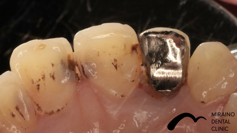 歯の破折予防：MTMの症例