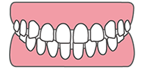 空隙歯列