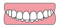 咬み合わせが深い（過蓋咬合）