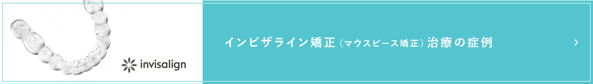 インビザライン（マウスピース矯正）治療の症例