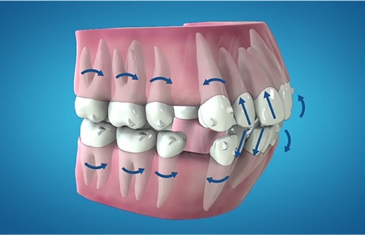 最先端の3Dデジタル機器を導入～口腔内スキャナーiTero（アイテロ）・歯科用CT～精密な型取りで歯並びのシミュレーションも
