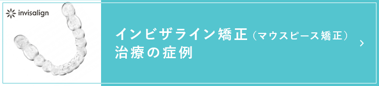 インビザライン（マウスピース矯正）治療の症例