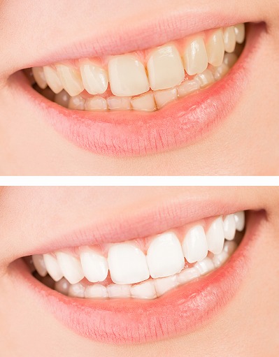 歯の黄ばみ・着色汚れを白くきれいにするホワイトニング